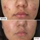 Centella Acne Care Soothing Fluid