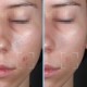 Purity Protocol – Clarifying serum with Salicylic Acid & Hyaluronic Acid