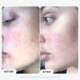 Azelaic Acid Booster