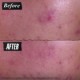 AcneTreat - Cleansing Paste